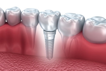 Zubní implantáty